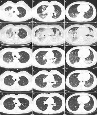 Acute respiratory distress syndrome caused by Chlamydia psittaci: a case report and literature review